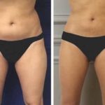 avant-apres-cryolipolyse-hanches